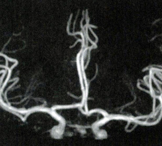 Angiogramm